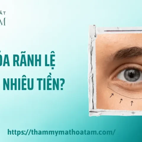 Xóa rãnh lệ bao nhiêu tiền phụ thuộc vào tình trạng vùng mắt và phương pháp được chỉ định