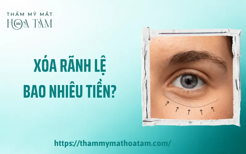 Xóa rãnh lệ bao nhiêu tiền phụ thuộc vào tình trạng vùng mắt và phương pháp được chỉ định